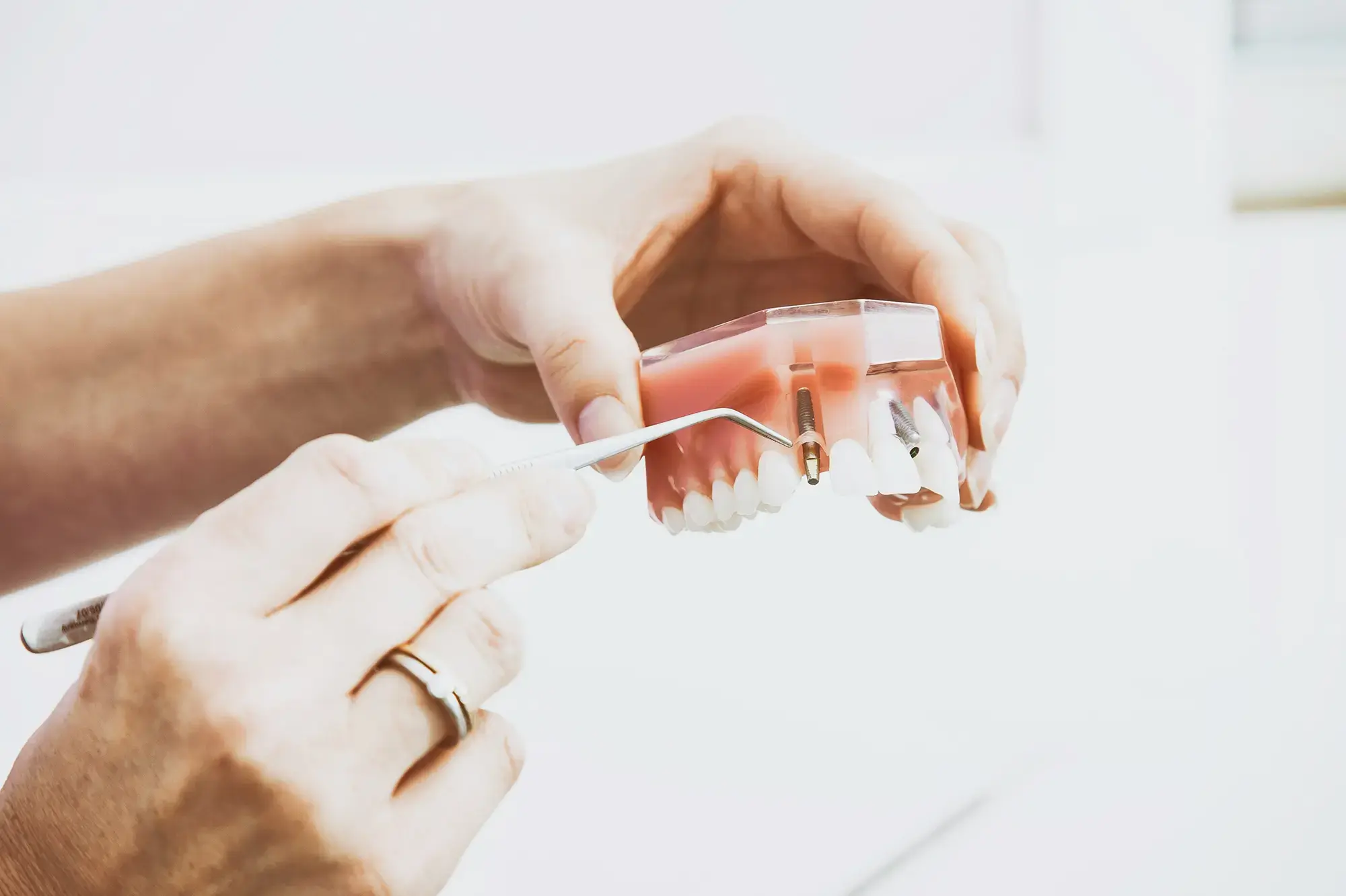 Hände halten ein Zahnersatzmodell und demonstrieren eine Implantatversorgung.